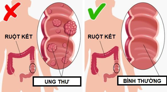 loi-ich-khi-an-dua-chuot-moi-ngay-2 Hạn chế nguy cơ mắc ung thư